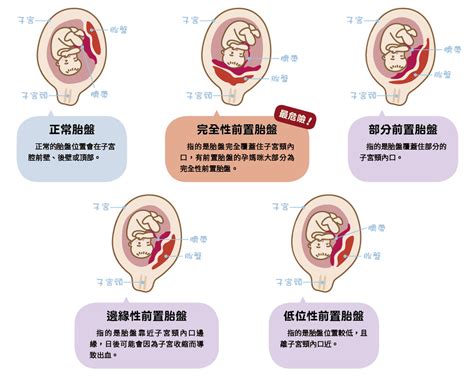 胎盤靠近子宮頸|前置胎盤